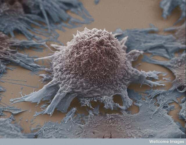 Le cancer est la première cause de mortalité en France. Ici, des cellules de cancer du poumon. © Anne Weston, Wellcome Images, Filckr nc nd 2.0