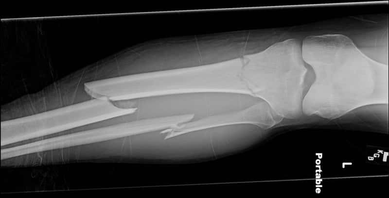 Les fractures surviennent en général suite à un choc violent. Plus les os sont fragiles et plus le risque de fracture est important. Contrairement aux idées reçues, les laitages ne solidifient pas les os. ©jennecy, FlickR, cc by nc nd 2.0      