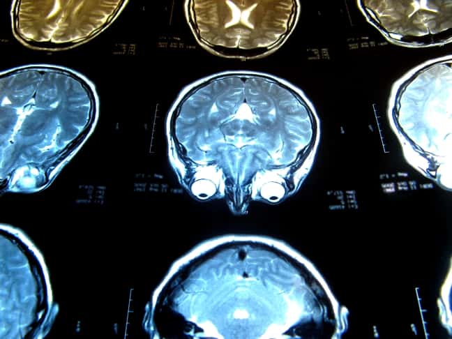 Les médecins peuvent dépister des lésions cérébrales par imagerie par résonance magnétique (IRM). Ces blessures pourraient-elles être réparées grâce à la thérapie génique ? © PhOtOnQuAnTiQuE, Flickr, cc by nc nd 2.0
