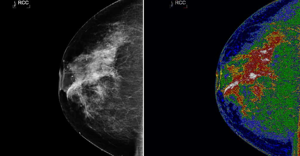 L'image de gauche montre une mammographie initiale avant le traitement MED - SEG . L'image sur la droite, avec la région d'intérêt (blanc ) marqué, montre une mammographie après le traitement MED - SEG . © NASA Goddard Space Flight Center - CC BY-NC 2.0