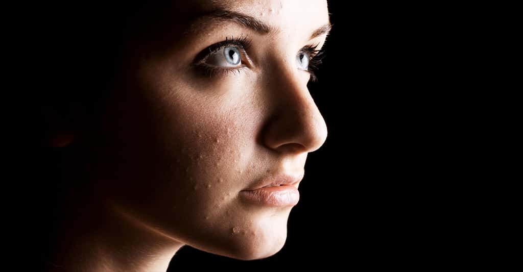 La localisation sur le visage de la rosacée pourrait induire le patient en erreur, mais l’acné a des caractéristiques bien précises. ©R.Iegosyn - Shutterstock