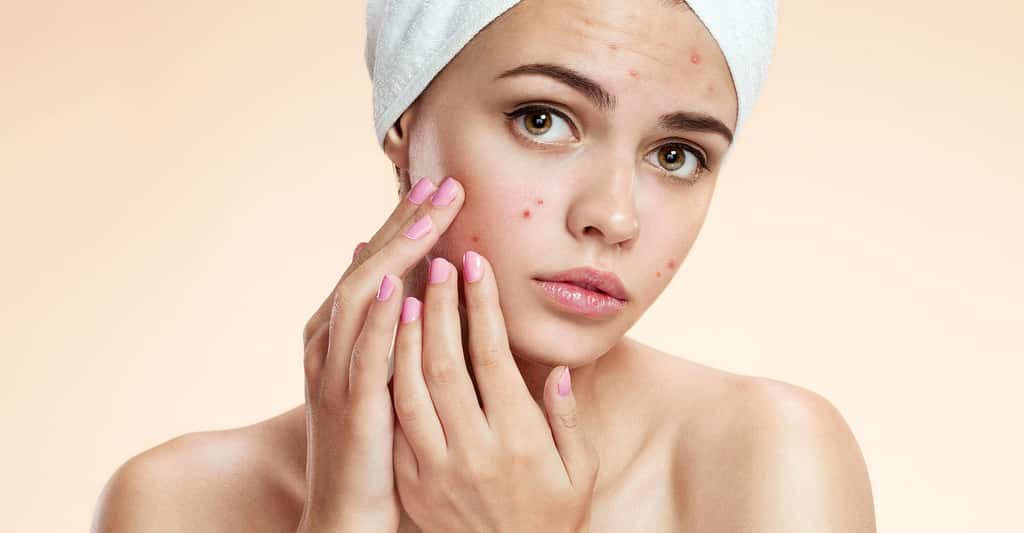 Acné : tout savoir sur l'acné
