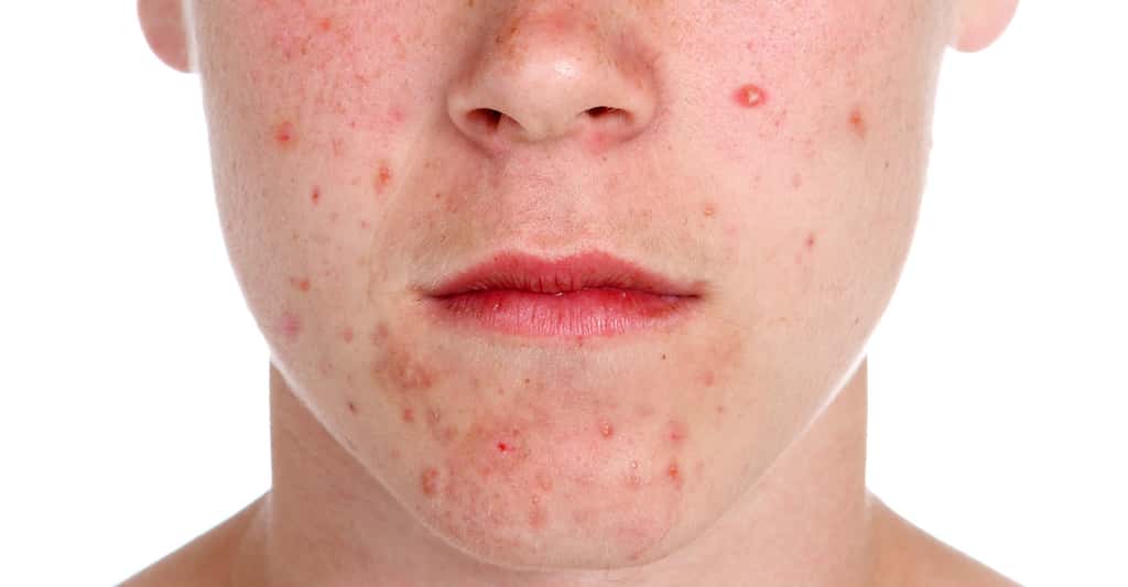 L'acné du visage : acné nodulokystique et acné fulminans