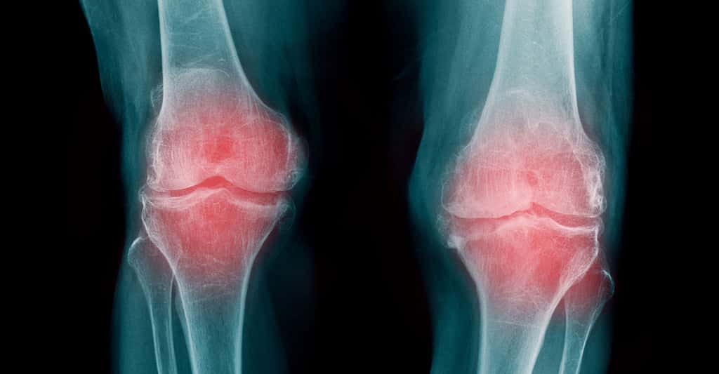Arthrose, ostéoporose : le vieillissement des articulations
