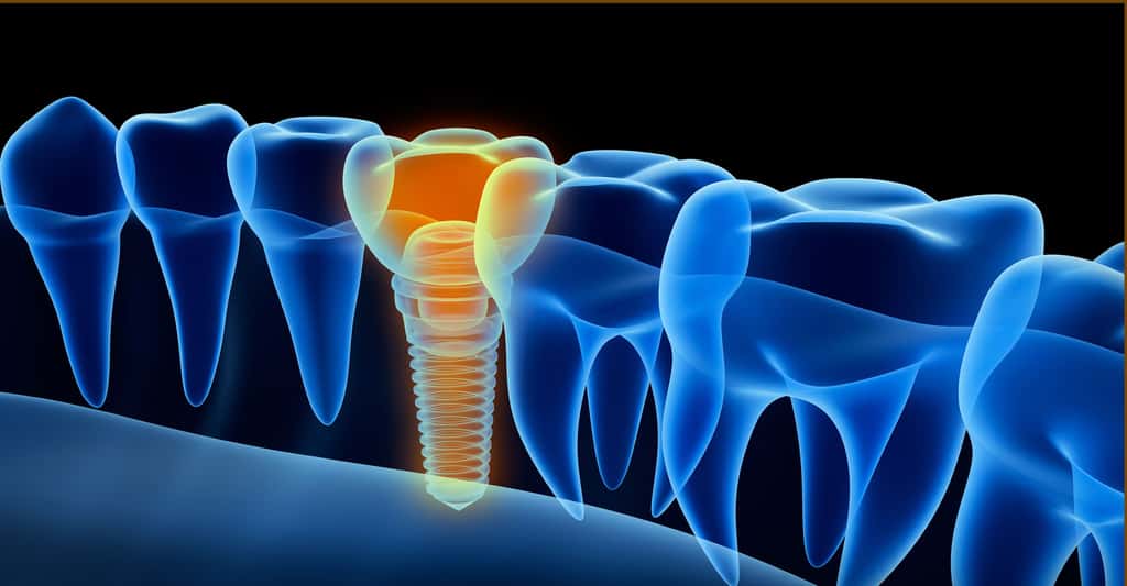 Les implants dentaires. © Alexandr Mitiuc, Fotolia