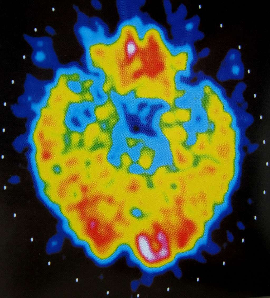 L’imagerie cérébrale montre que la maladie d’Alzheimer débute par une nécrose des hippocampes (parties bleues des deux côtés du cerveau) qui permettent l’enregistrement des nouveaux souvenirs. © Alain Lieury
