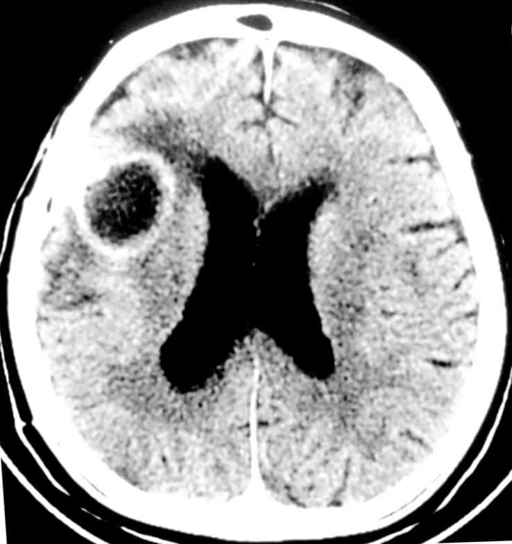 Scanner cérébral montrant un abcès frontal droit sous la forme d'une poche de liquide entourée d'une zone d'œdème. Le ventricule latéral droit est légèrement refoulé. © Patrick Vertischel