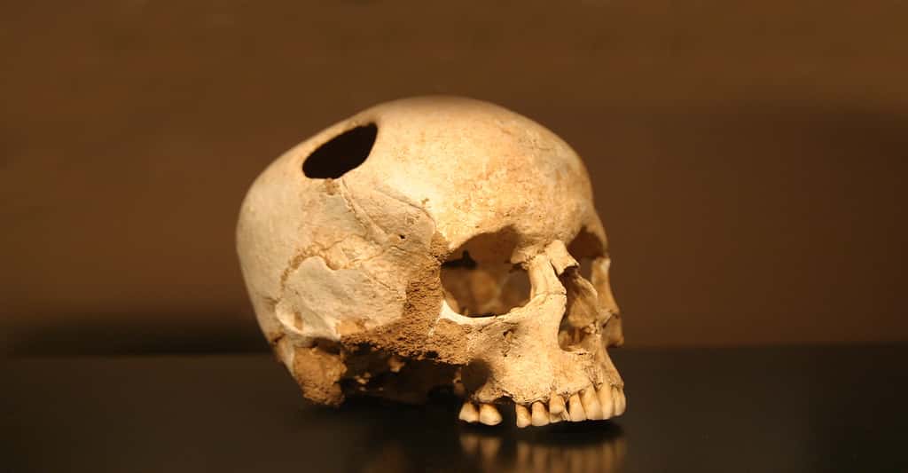 Crâne trépané (environ 3500 avant J.-C.) d’une fillette ayant survécu à l’opération, comme en atteste la légère pousse de l’os en bordure du trou (musée d’histoire naturelle de Lausanne).© Rama, <em>Wikimedia commons,</em> CC by-sa 3.0 FR