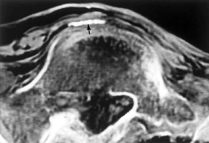 La flèche noire montre la présence d'une calcification située dans l'aorte abdominale. Cliché réalisé en mai 1994. © Murphy W.A. <em>et alii, The Iceman: Discovery and Imaging</em>, RSNA, 2003. 