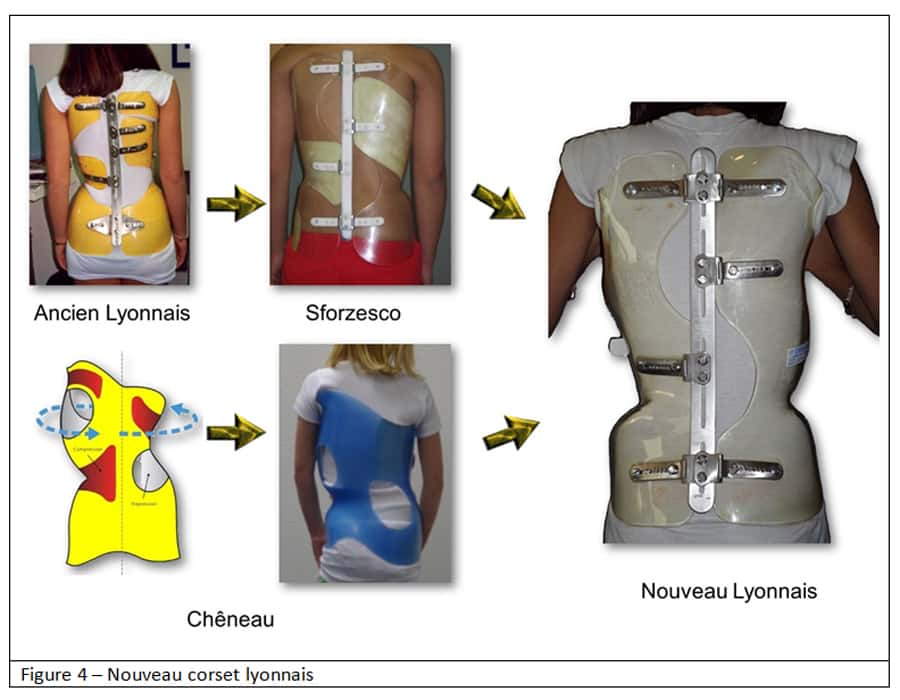 Le nouveau corset lyonnais a fait progresser le traitement de la scoliose. © Docteur Jean Claude de Mauroy - Tous droits réservés/Reproduction interdite