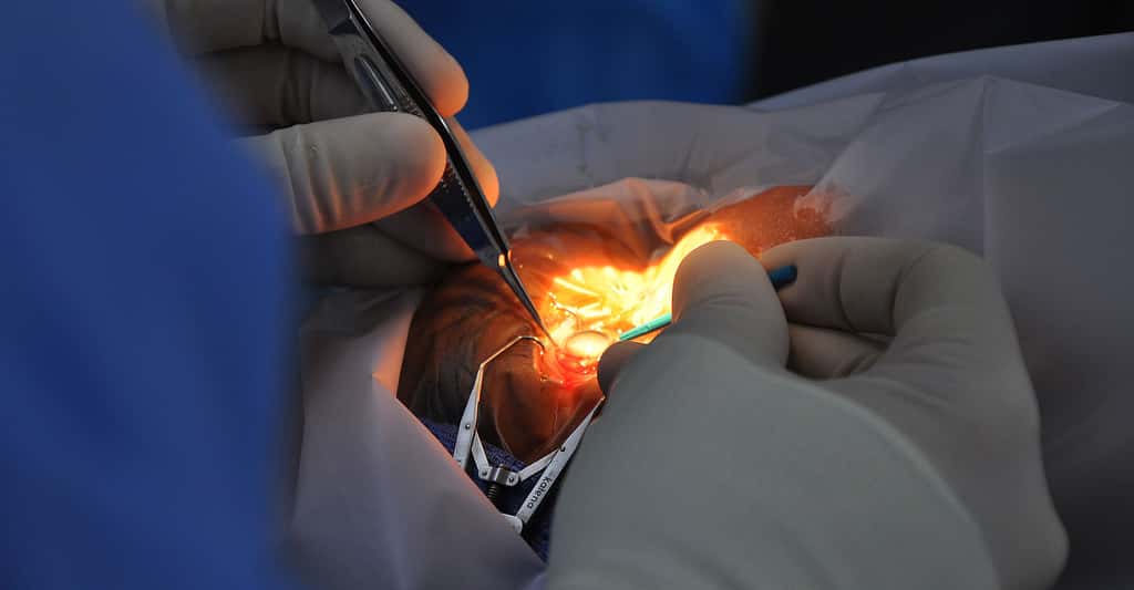 Opération de la cataracte : traitement chirurgical