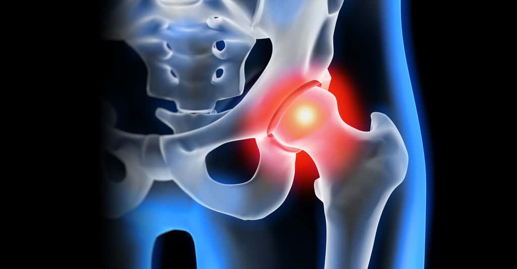 Arthrose de la hanche : la coxarthrose