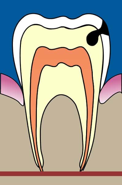 La carie attaque la dent en y faisant un trou. © Wikipedia, Licence Art libre