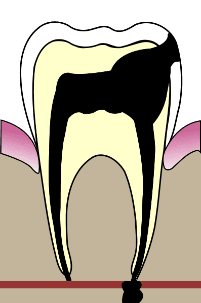 Quand la carie se complique, elle peut engendrer une nécrose de la dent, appelée cellulite faciale. © Wikipédia, Licence Art libre