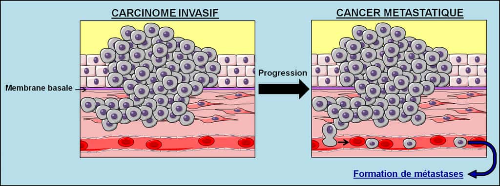 Figure 5. Les stades cancéreux de l’oncogenèse. Au moment où la tumeur rompt la membrane basale, le carcinome invasif est atteint et le cancer est déclaré. Le cancer peut évoluer jusqu’au stade final de l’oncogenèse, qui est le cancer métastatique. © Grégory Ségala
