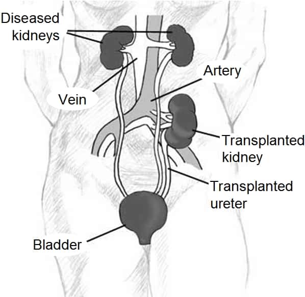 La greffe de rein ou transplantation rénale