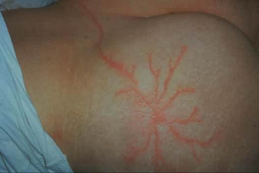 Figure de Lichtenberg sur la peau. © Avec l'autorisation de l'Hôpital de Chamonix-Mont-Blanc