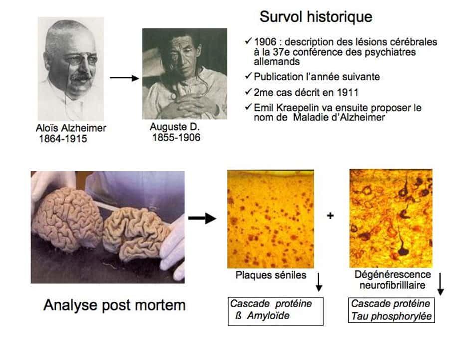 Aloïs Alzheimer a suivi la patiente Auguste Deter (sur la photo ci-dessus) jusqu’à sa mort en 1906. Il a décrit son cerveau à la 37<sup>e</sup> conférence des psychiatres allemands. © DR