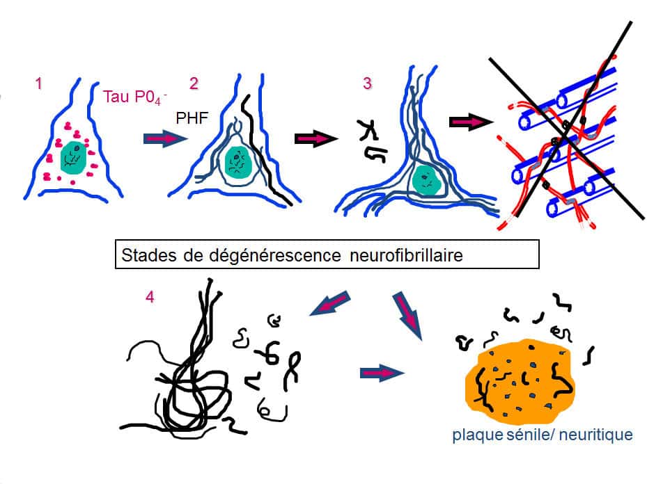 La dégénérescence neurofibrillaire affecte principalement les grands neurones pyramidaux de l’hippocampe. © DR