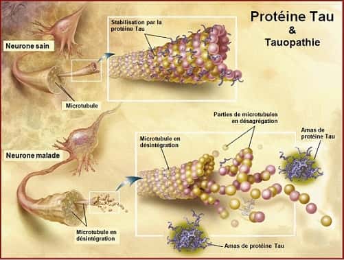 La protéine Tau dans un neurone sain et dans un neurone malade. © Zwarck, Wikipédia, cc by sa 2.5 