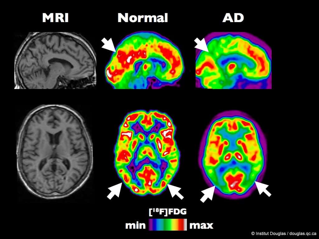  Tomographie par émission de positons (<em>PET</em><em> Scan</em> en anglais) d’un cerveau en santé en comparaison avec un cerveau atteint d’Alzheimer à un stade précoce. © Institut Douglas, Flickr, Licence Creative Commons, by nc sa 2.0