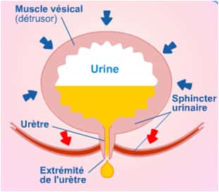 On différencie trois types d'incontinence urinaire. Sur ce schéma, mécanisme de l’incontinence à l’effort. © incontinence- protection, DR