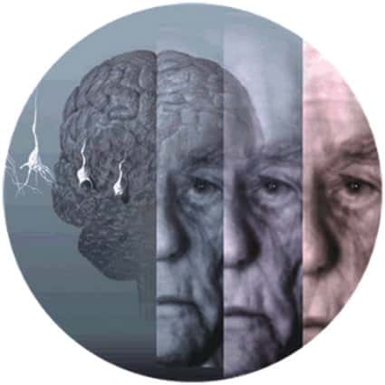 La maladie d'Alzheimer fait partie des maladies du cerveau, que l'on appelle maladies neurodégénératives. © DR