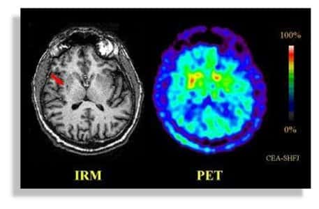 <br />Une image du cerveau obtenue par IRM et par la tomographie à émission de positrons