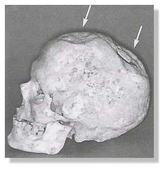 Évidence d'une intervention neurochirurgicale de l'époque préhistorique. Ce crâne humain date de plus de 7.000 ans. Il a fait l'objet d'une intervention du vivant du sujet. © Alt et al., 1997, Fig. 1a