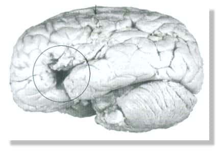<br />Photographie du cerveau à partir duquel Broca établit la théorie de la localisation des fonctions cérébrales. Ce cerveau est celui du patient ayant perdu l'usage de la parole avant son décès en 1861. La lésion qui produit ce genre de déficit est identifiée par un cercle. © Corsi, 1991, Fig. III. 4