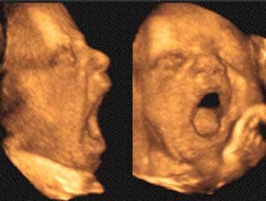 Un fœtus de 23 semaines bâille déjà. La fréquence des bâillements est élevée chez les bébés et commence à diminuer quand la durée du sommeil décroît, après un an. © Olivier Walusinski, tous droits réservés