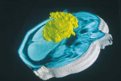 <br />Visualisation simultanée de la peau et d'une tumeur par imagerie par résonance magnétique (IRM). De telles images peuvent être utilisées en neurochirurgie pour le guidage d'instruments lors d'opérations sur le cerveau (chirurgie assistée par ordinateur). &copy; CNRS Photothèque  - Reproduction et utilisation interdites 