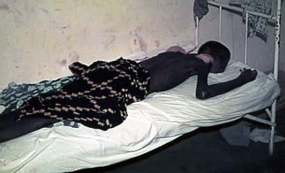 <br />Photo : 3 - Malade en phase terminale de la maladie du sommeil (coma évoluant vers la mort) <br />&copy; Gérard Duvallet.
