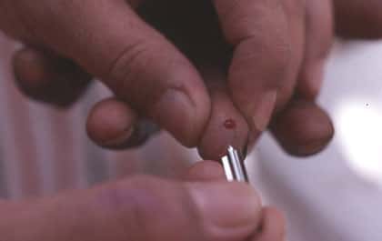 <br />Photo : 16 - Collecte d'une goutte de sang à l'extrémité du doigt pour des examens parasitologiques et sérologiques. <br />&copy; Gérard Duvallet