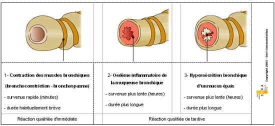 Figure 2 : Mécanisme de l'obstruction de la bronche dans la crise d'asthme Marchand, 2005.