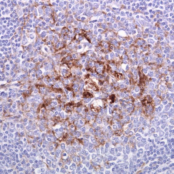 Biopsie d’une amygdale d’un malade de la variante de la maladie de Creutzfeldt-Jakob. © Sbrandner, cc by-sa 3.0