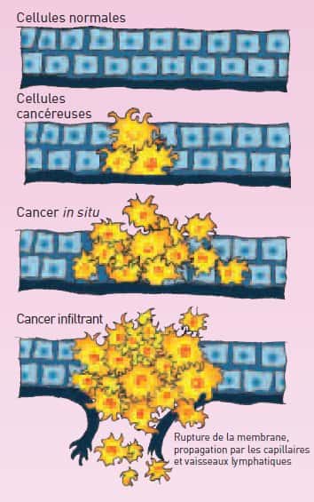 Les différents comportements des cellules cancéreuses. © INCA 