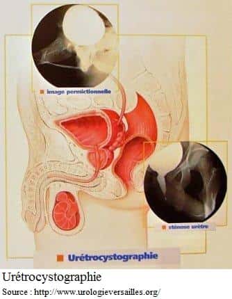 L’urétrocystographie permet la rechercher d’une anomalie de la morphologie vésicale. © DR