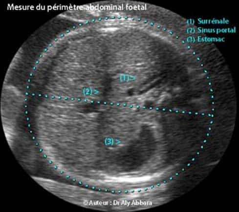 Première échographie : mesure du DAT (diamètre abdominal transverse) et du PA (périmètre abdominal). © aly-abbara.com