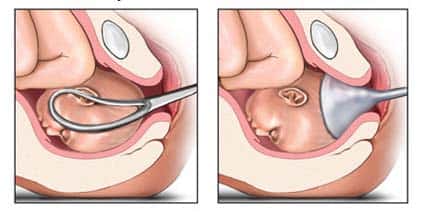 Dans certains accouchements, des forceps et une ventouse s’imposent<br>pour faciliter l’expulsion du bébé. © DR