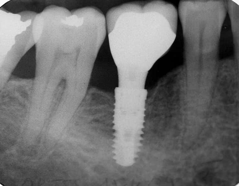 La chirurgie dentaire permet aujourd'hui de redonner des dents de façon plus simple et plus esthétique qu'avant. Sur cette radiographie, un implant dentaire sur une molaire. © jbessade, Wikipedia, CC by-sa 30