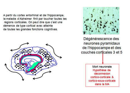 Quand la maladie d’Alzheimer (MA) atteint l’ensemble des régions corticales, toutes les grandes fonctions cognitives sont atteintes. ©  DR