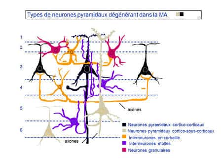 <br />Les types de neurones pyramidaux dégénérant dans la maladie d’Alzheimer (MA) sont les cortico-corticaux et les cortico-sous-corticaux. © DR