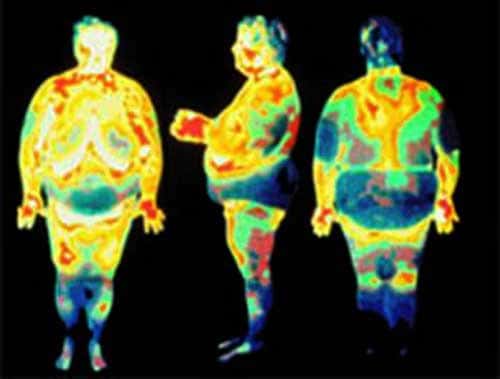 Thermométrie de l'obésité