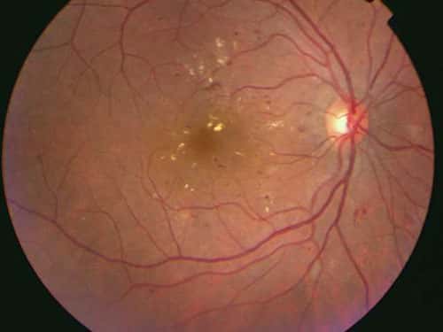 Fond d'œil, la macula est au centre, sombre, le disque optique à droite de l'image. On voit les vaisseaux sanguins et le fond d'œil peut être un bon outil non invasif de détection de certains désordres physiologiques. © Reproduction et utilisation interdites 