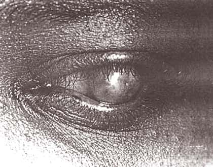 Trachome, perforation. © Reproduction et utilisation interdites 