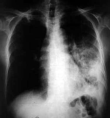 Radiographie de tuberculose pulmonaire