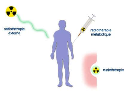 Les trois méthodes d’utilisation de radioéléments pour soigner les cances : radiothérapie externe (rayons X puis « bombes » et accélérateurs), radiothérapie interne ou curiethérapie (aiguilles de radium puis fils ou grains d’iridium) et radiothérapie métabolique (comme l’injection d’iode).