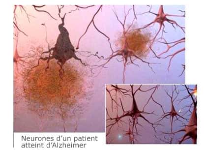 Présence de plaques séniles entre les cellules nerveuses. En bas à droite, neurones d’un patient sain. Source: ©2007 Alzheimer's Association.  <a href="http://www.alz.org/" target="_blank">www.alz.org</a>.  All rights reserved. Illustrations by Stacy Janis.