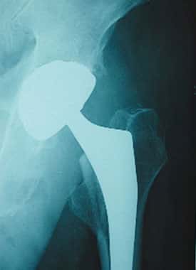 Radiographie de prothèse de hanche. Source : <a target="_blank" href="http://www.maitrise-orthop.com/">Maîtrise orthopédique</a>
